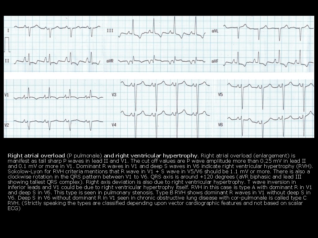 Right atrial overload (P pulmonale) and right ventricular hypertrophy. Right atrial overload (enlargement) is