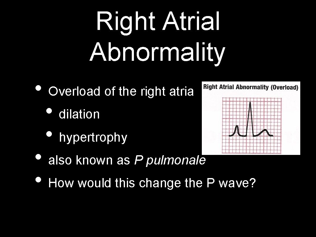 Right Atrial Abnormality • Overload of the right atria • dilation • hypertrophy •