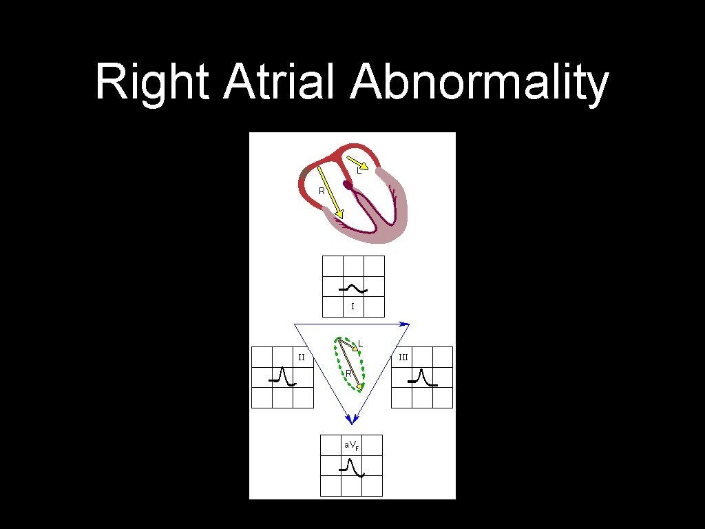 Right Atrial Abnormality 