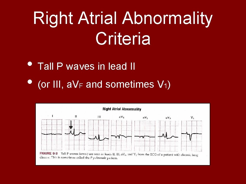 Right Atrial Abnormality Criteria • Tall P waves in lead II • (or III,