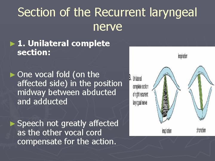 Section of the Recurrent laryngeal nerve ► 1. Unilateral complete section: ► One vocal