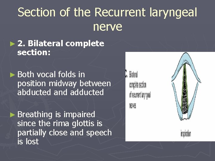 Section of the Recurrent laryngeal nerve ► 2. Bilateral complete section: ► Both vocal Section of the Recurrent laryngeal nerve ► 2. Bilateral complete section: ► Both vocal