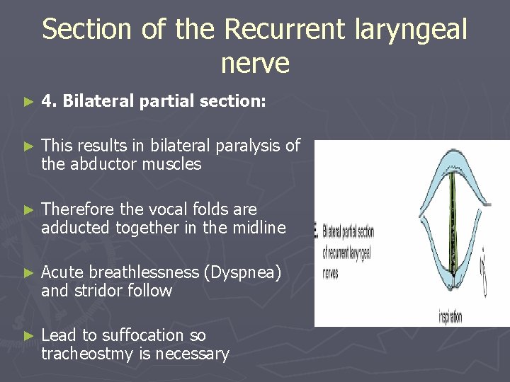 Section of the Recurrent laryngeal nerve ► 4. Bilateral partial section: ► This results