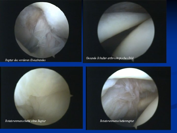  Ruptur des vorderen Kreuzbandes Rotatorenmanschette ohne Ruptur Gesunde Schulter arthroskopisches Bild Rotatorenmanschettenruptur 