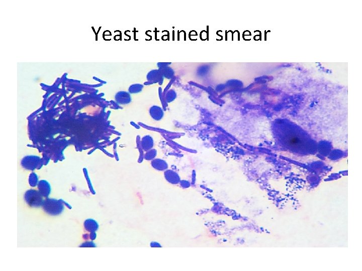 Yeast stained smear 
