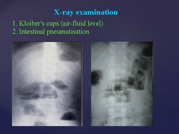 X-ray examination 1. Kloiber's cups (air-fluid level) 2. Intestinal pneumatisation 