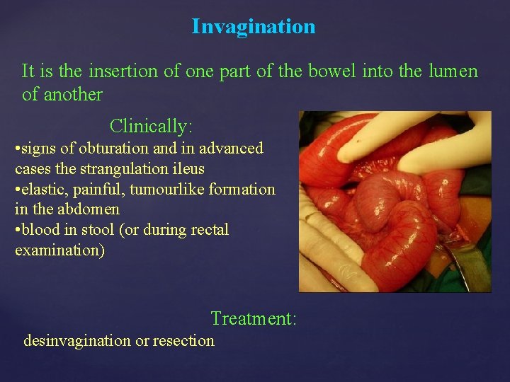 Invagination It is the insertion of one part of the bowel into the lumen