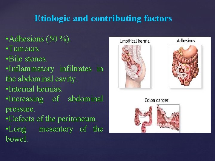 Etiologic and contributing factors • Adhesions (50 %). • Tumours. • Bile stones. •