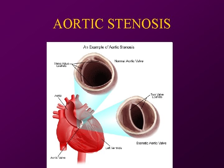 AORTIC STENOSIS 