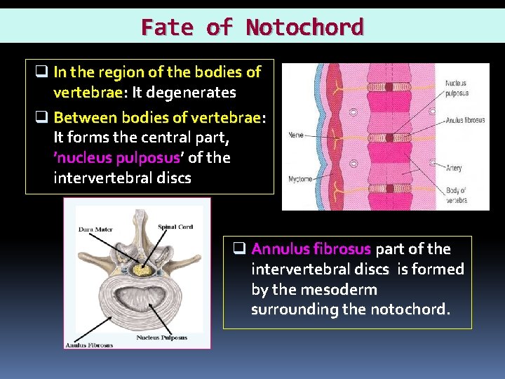 Fate of Notochord q In the region of the bodies of vertebrae: It degenerates