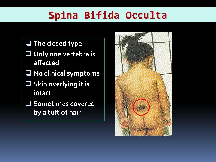 Spina Bifida Occulta q The closed type q Only one vertebra is affected q