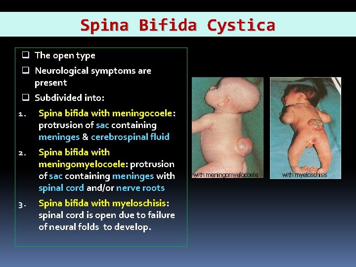 Spina Bifida Cystica q The open type q Neurological symptoms are present q Subdivided