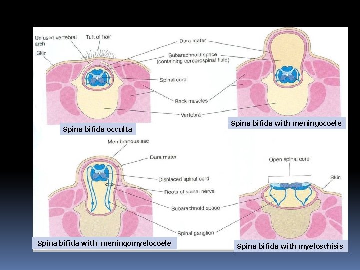 Spina bifida occulta Spina bifida with meningomyelocoele Spina bifida with meningocoele Spina bifida with