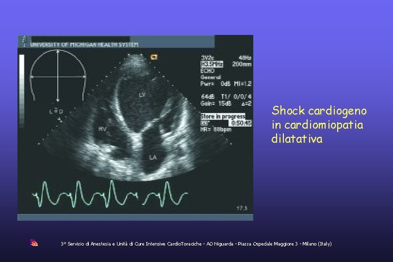 Shock cardiogeno in cardiomiopatia dilatativa 3° Servizio di Anestesia e Unità di Cure Intensive