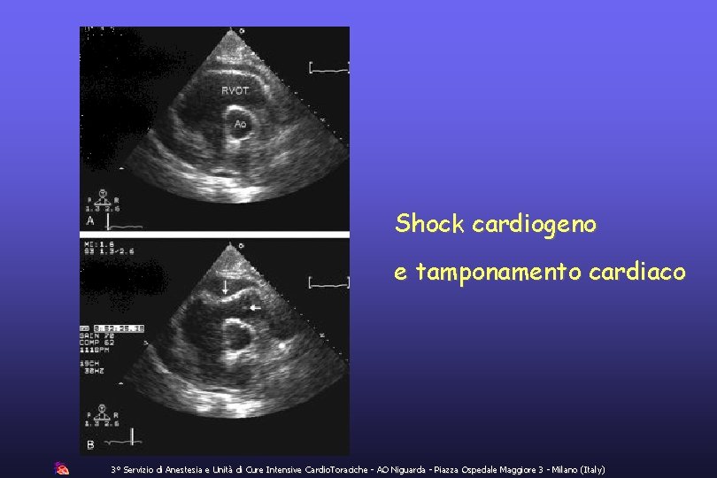 Shock cardiogeno e tamponamento cardiaco 3° Servizio di Anestesia e Unità di Cure Intensive