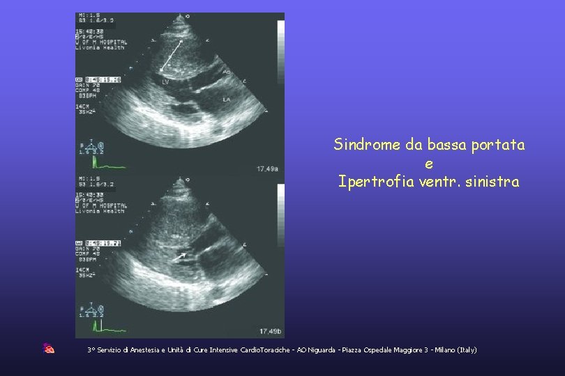 Sindrome da bassa portata e Ipertrofia ventr. sinistra 3° Servizio di Anestesia e Unità