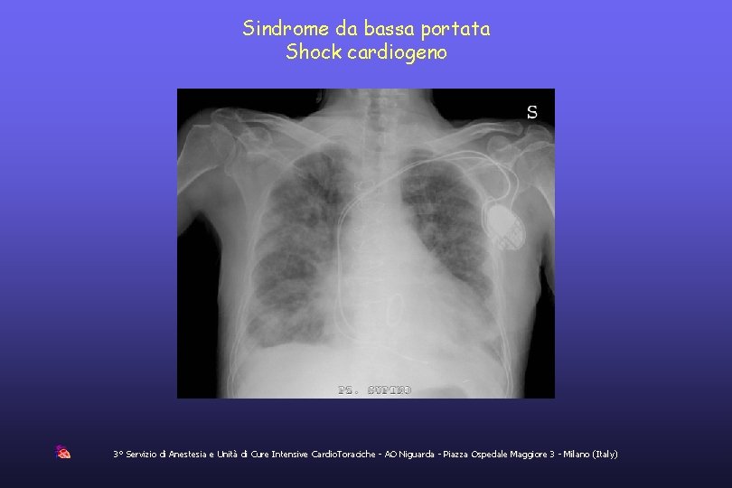 Sindrome da bassa portata Shock cardiogeno 3° Servizio di Anestesia e Unità di Cure
