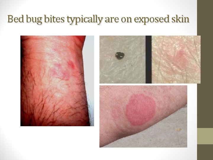 Bed bug bites typically are on exposed skin 