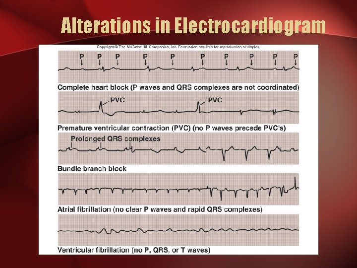 Alterations in Electrocardiogram 