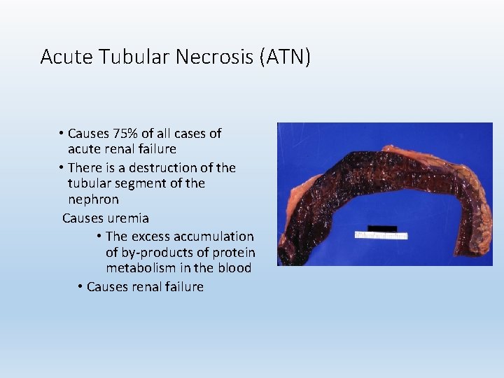 Acute Tubular Necrosis (ATN) • Causes 75% of all cases of acute renal failure