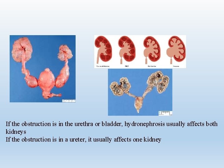 If the obstruction is in the urethra or bladder, hydronephrosis usually affects both kidneys