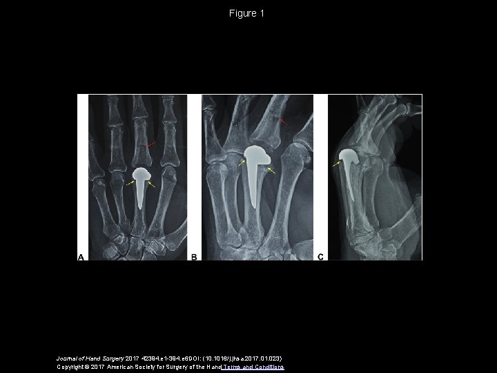 Figure 1 Journal of Hand Surgery 2017 42394. e 1 -394. e 6 DOI:
