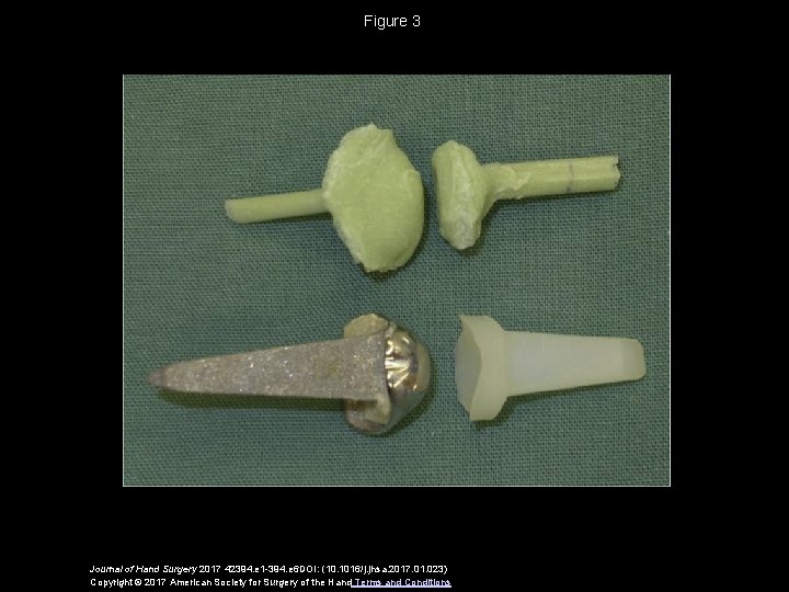 Figure 3 Journal of Hand Surgery 2017 42394. e 1 -394. e 6 DOI:
