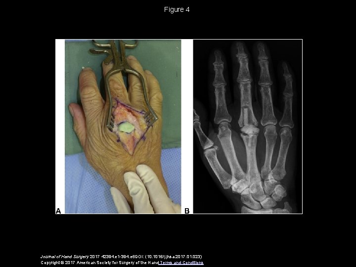 Figure 4 Journal of Hand Surgery 2017 42394. e 1 -394. e 6 DOI: