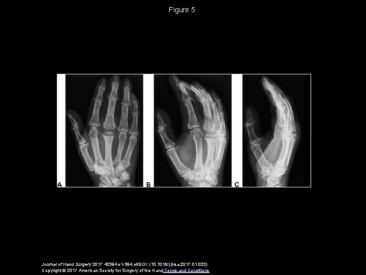 Figure 5 Journal of Hand Surgery 2017 42394. e 1 -394. e 6 DOI: