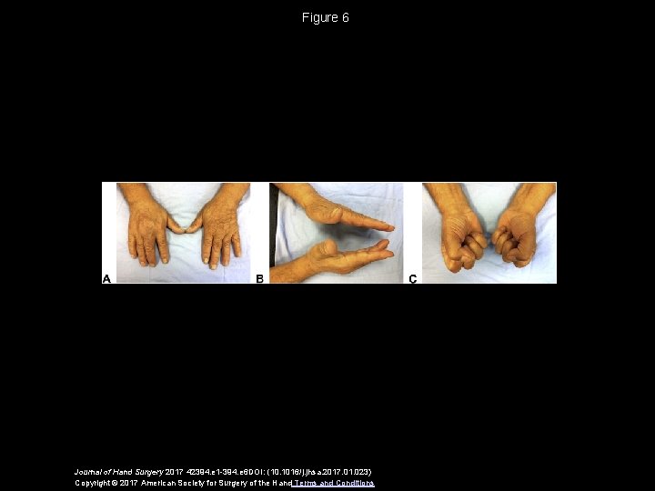 Figure 6 Journal of Hand Surgery 2017 42394. e 1 -394. e 6 DOI: