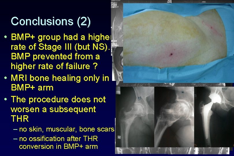 Conclusions (2) • BMP+ group had a higher rate of Stage III (but NS).