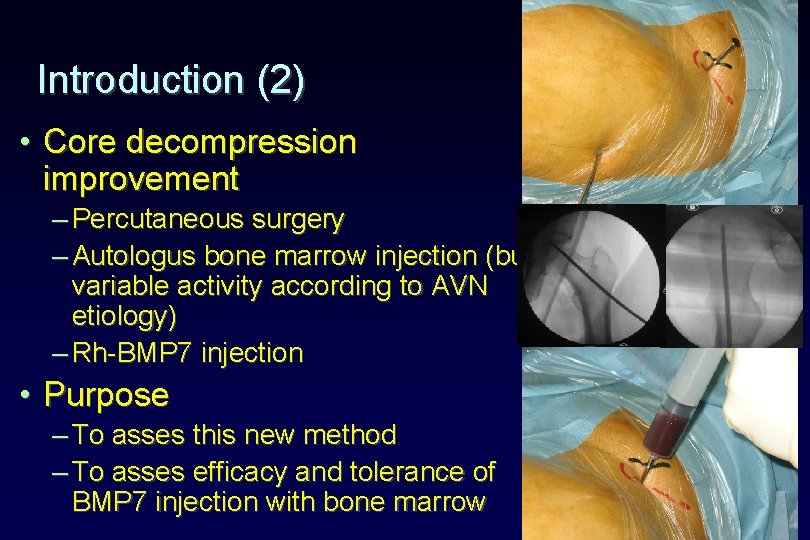 Introduction (2) • Core decompression improvement – Percutaneous surgery – Autologus bone marrow injection