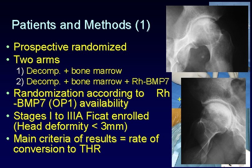 Patients and Methods (1) • Prospective randomized • Two arms 1) Decomp. + bone