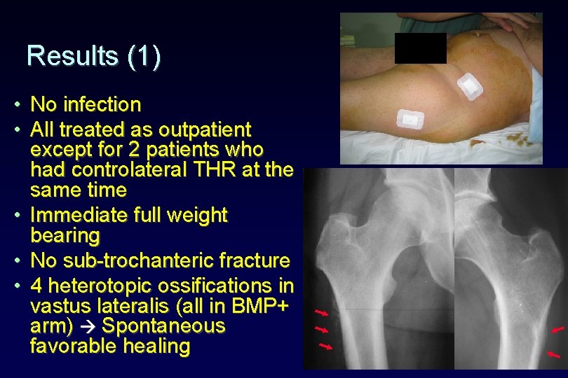 Results (1) • No infection • All treated as outpatient except for 2 patients