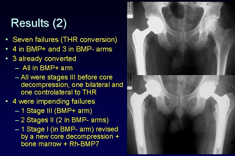 Results (2) • • • Seven failures (THR conversion) 4 in BMP+ and 3