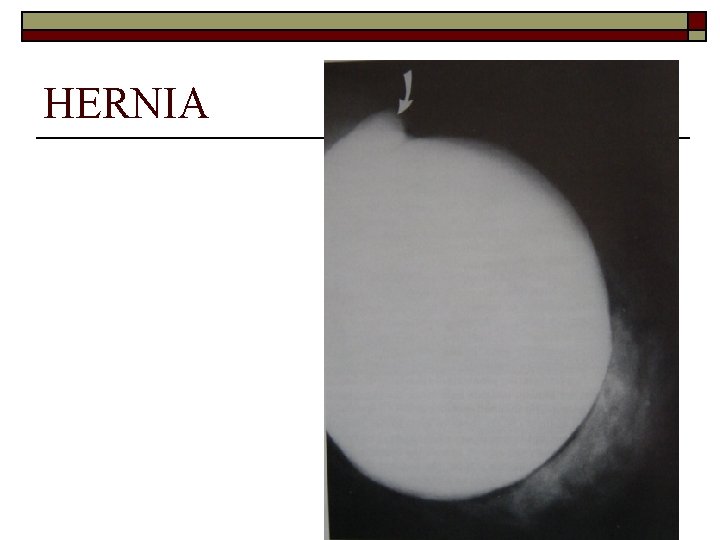 HERNIA 