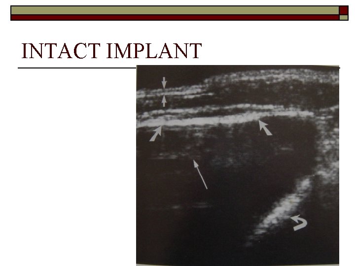INTACT IMPLANT 