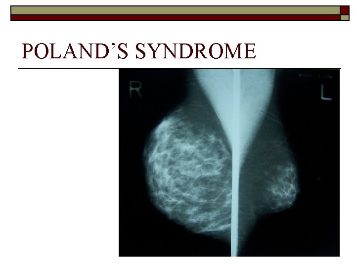 POLAND’S SYNDROME 