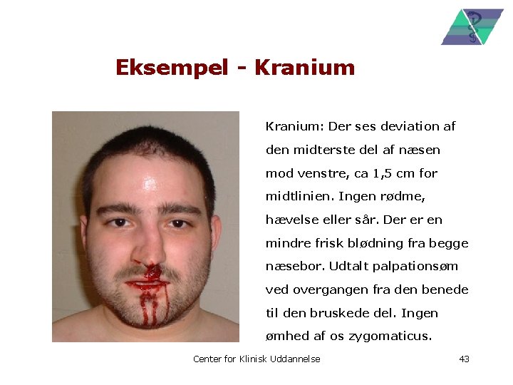 Eksempel - Kranium: Der ses deviation af den midterste del af næsen mod venstre,