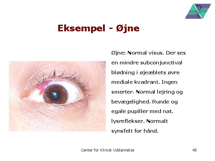 Eksempel - Øjne: Normal visus. Der ses en mindre subconjunctival blødning i øjeæblets øvre
