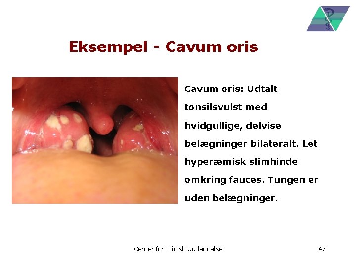 Eksempel - Cavum oris: Udtalt tonsilsvulst med hvidgullige, delvise belægninger bilateralt. Let hyperæmisk slimhinde