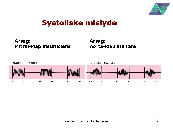 Systoliske mislyde Årsag: Mitral-klap insufficiens Årsag: Aorta-klap stenose Center for Klinisk Uddannelse 57 