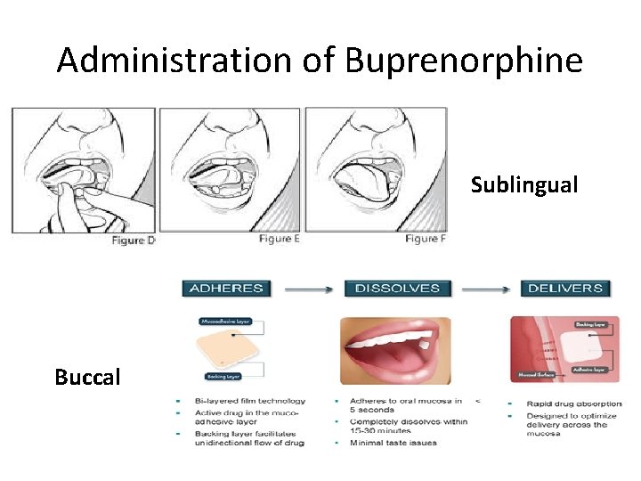 Administration of Buprenorphine Sublingual Buccal 