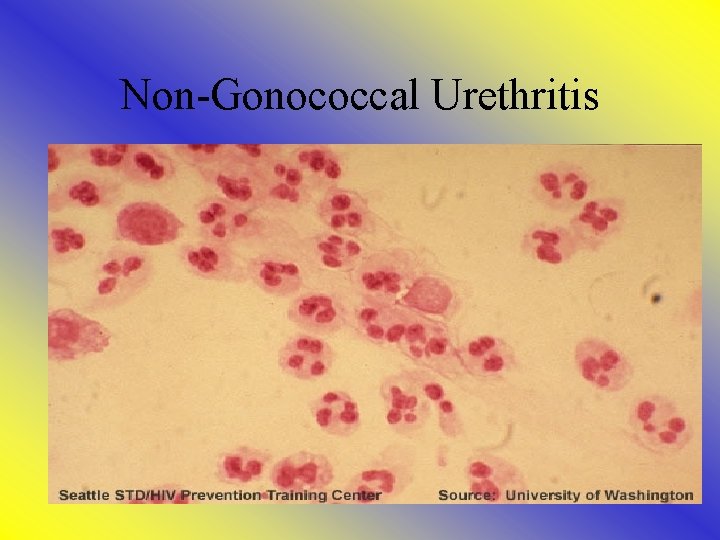 Non-Gonococcal Urethritis 