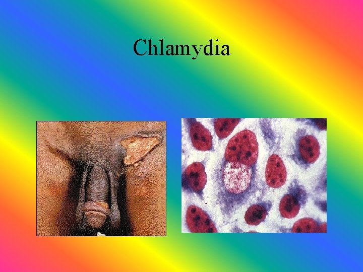 Chlamydia 