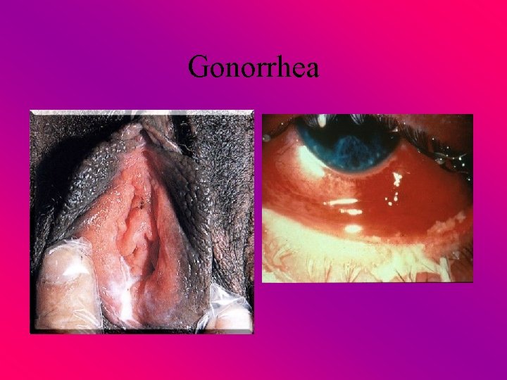 Gonorrhea 