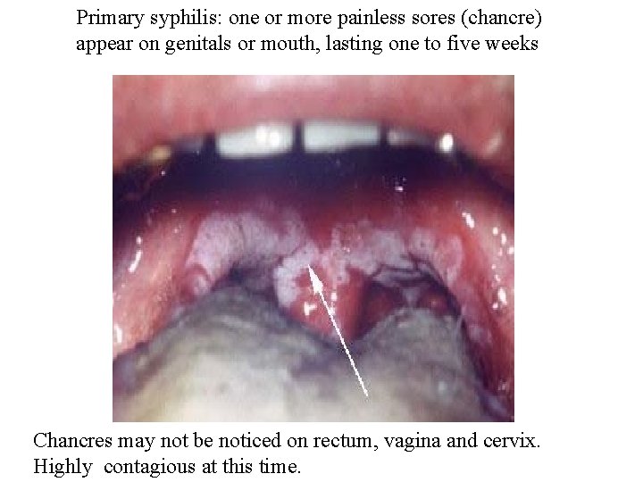 Primary syphilis: one or more painless sores (chancre) appear on genitals or mouth, lasting