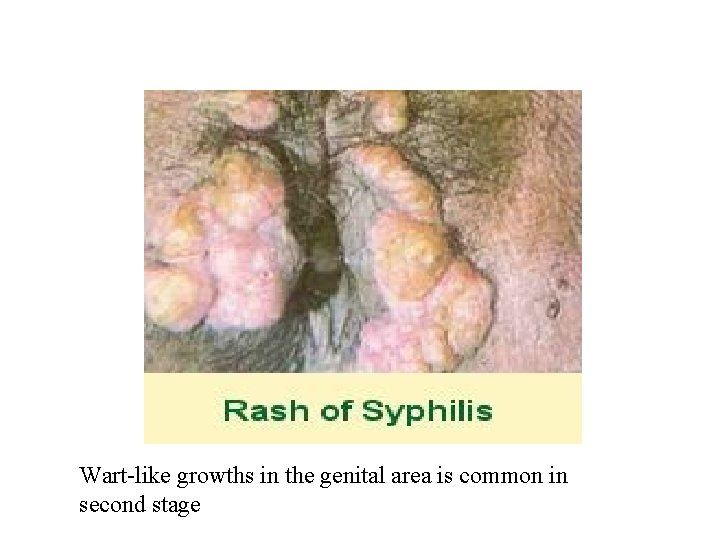 Wart-like growths in the genital area is common in second stage 