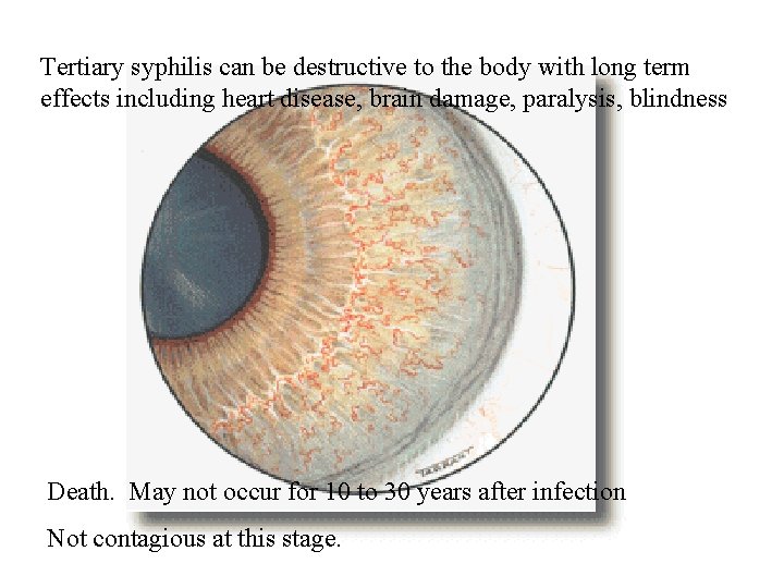 Tertiary syphilis can be destructive to the body with long term effects including heart