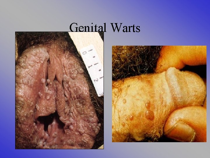 Genital Warts 
